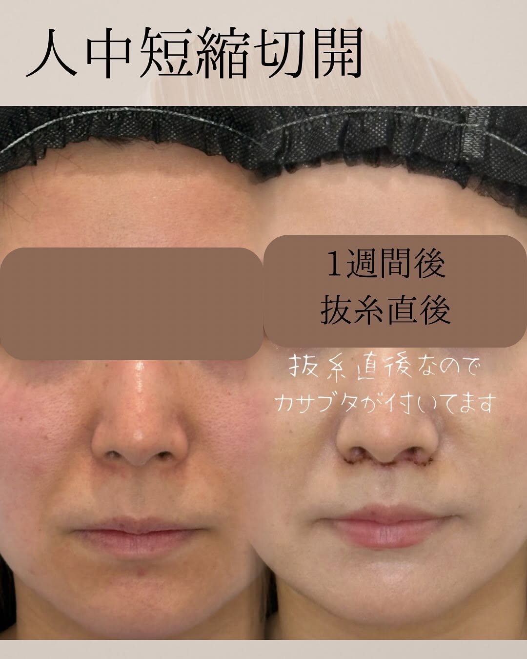 症例