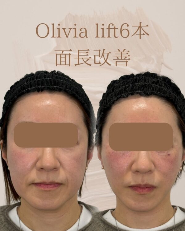 17 Olivia lift 6本