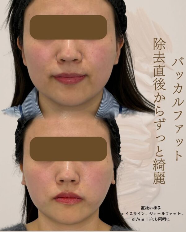 21 Olivia式小顔脂肪吸引 × バッカルファット除去