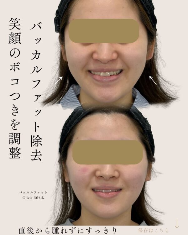 24 バッカルファット除去 × Olivia lift