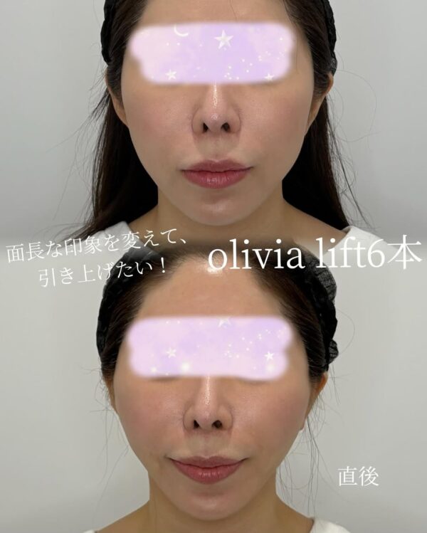 4 Olivia lift 6本