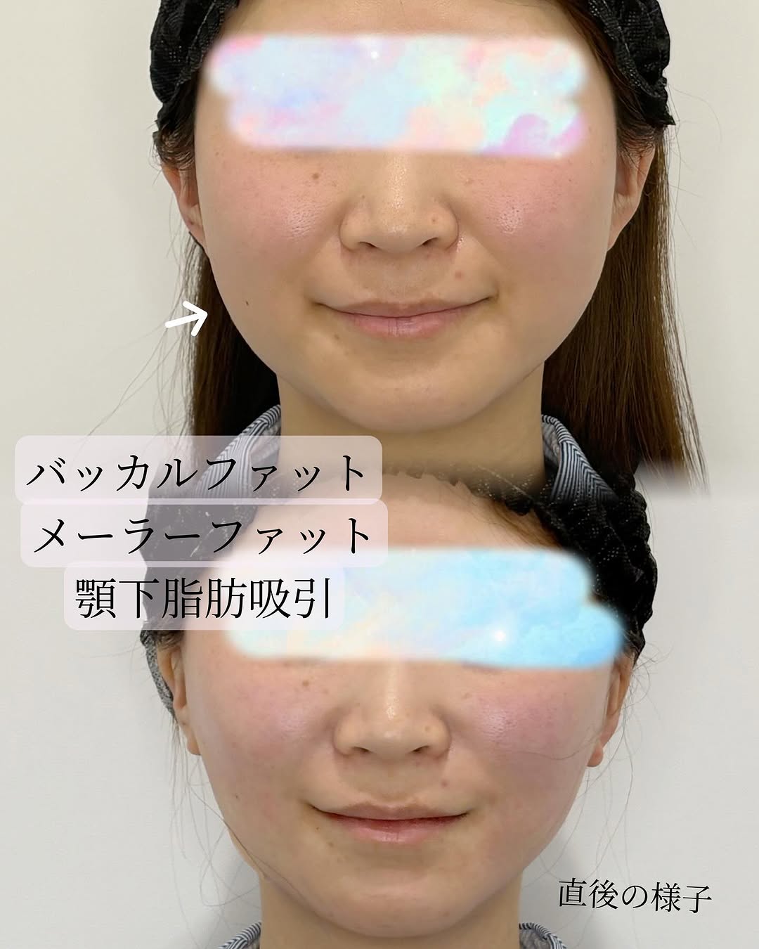症例
