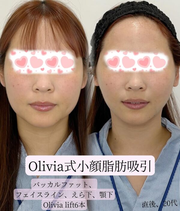 6 Olivia式小顔脂肪吸引 × バッカルファット除去