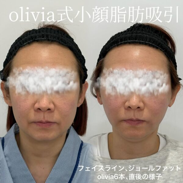 30 Olivia式小顔脂肪吸引