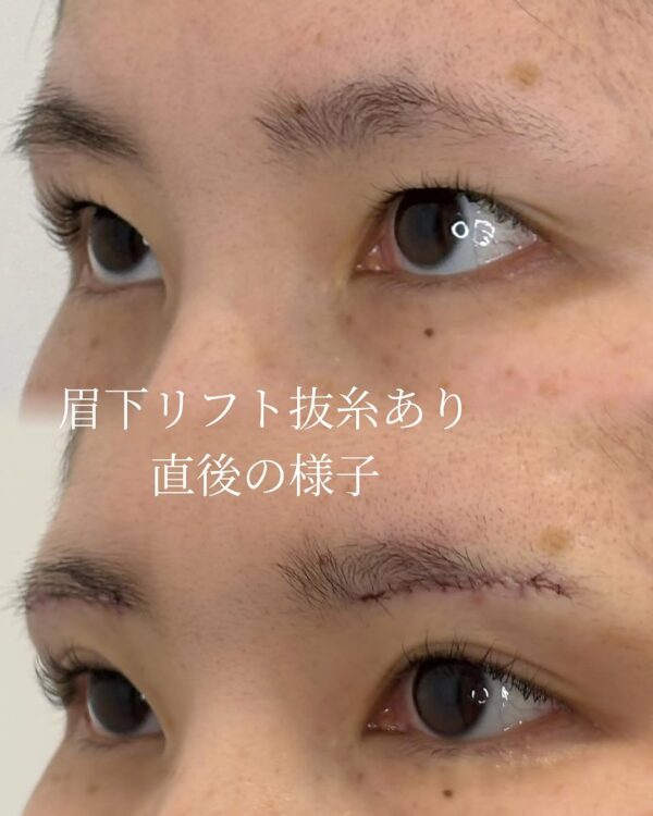 33 眉下リフト