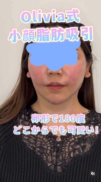 34 Olivia式小顔脂肪吸引