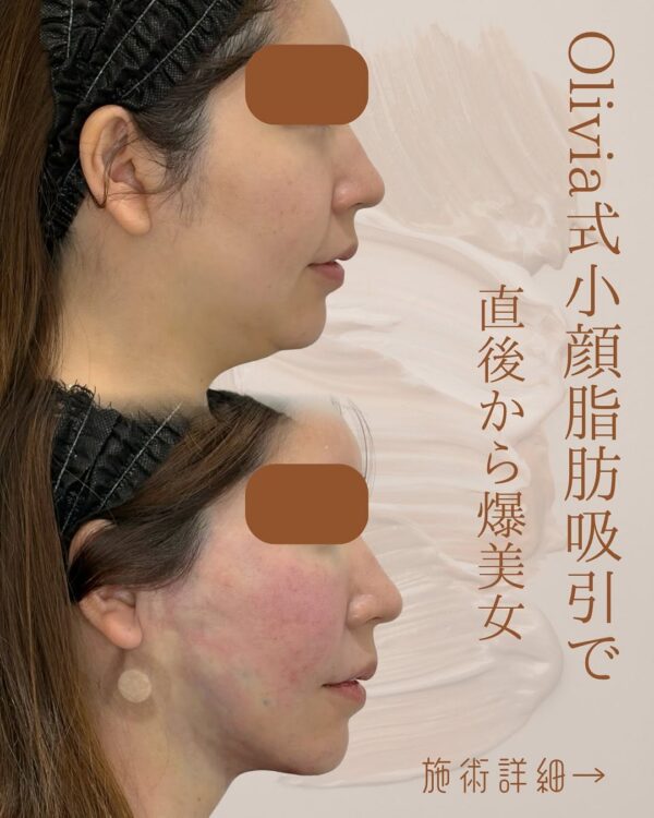 35 Olivia式小顔脂肪吸引 × ペリカンリフト × ナゾラビアルファット除去 × 顔の横幅縮小