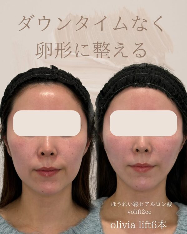 36 Olivia Lift × ヒアルロン酸