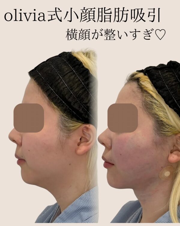42 Olivia式小顔脂肪吸引 × ペリカンリフト × ナゾラビアルファット除去 × 顔の横幅縮小 × ヒアルロン酸