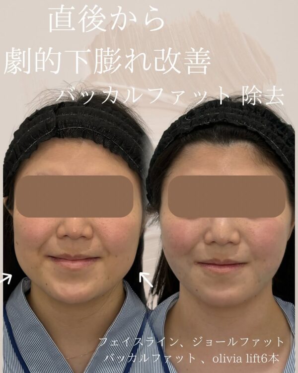 48 Olivia式小顔脂肪吸引 × バッカルファット除去 × ジョールファット除去