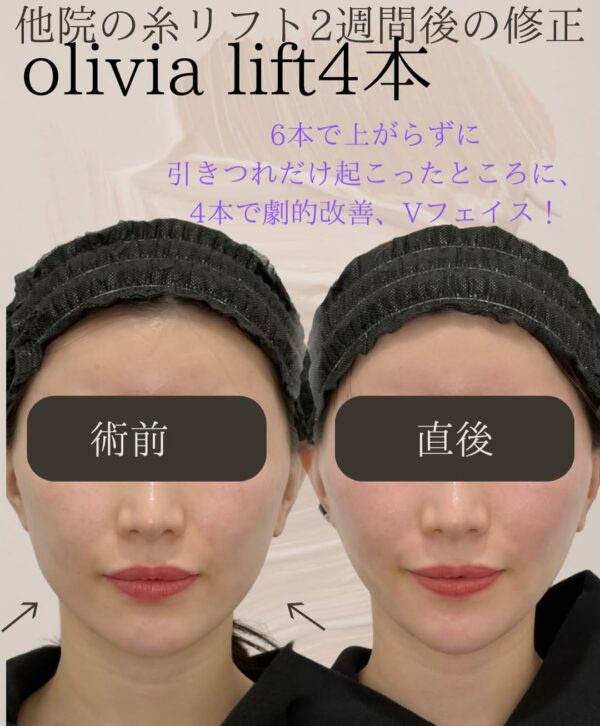 50 Olivia lift