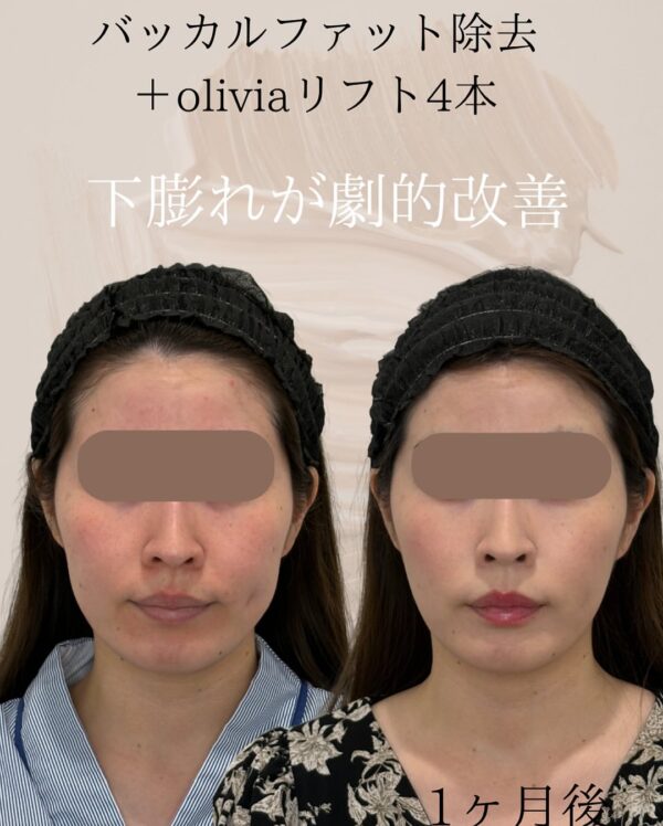 108 バッカルファット除去 × Olivia lift