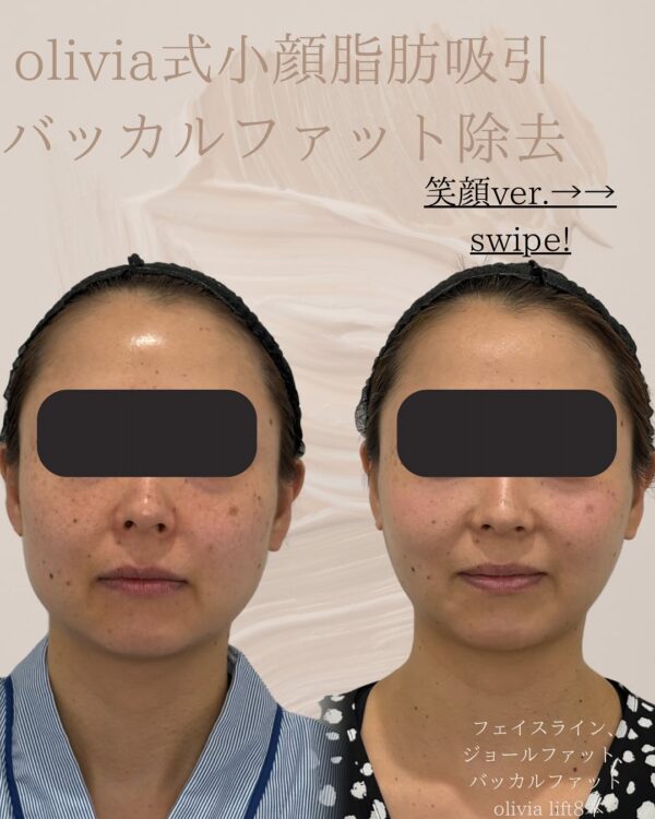 55 Olivia式小顔脂肪吸引 × バッカルファット除去 × ジョールファット除去