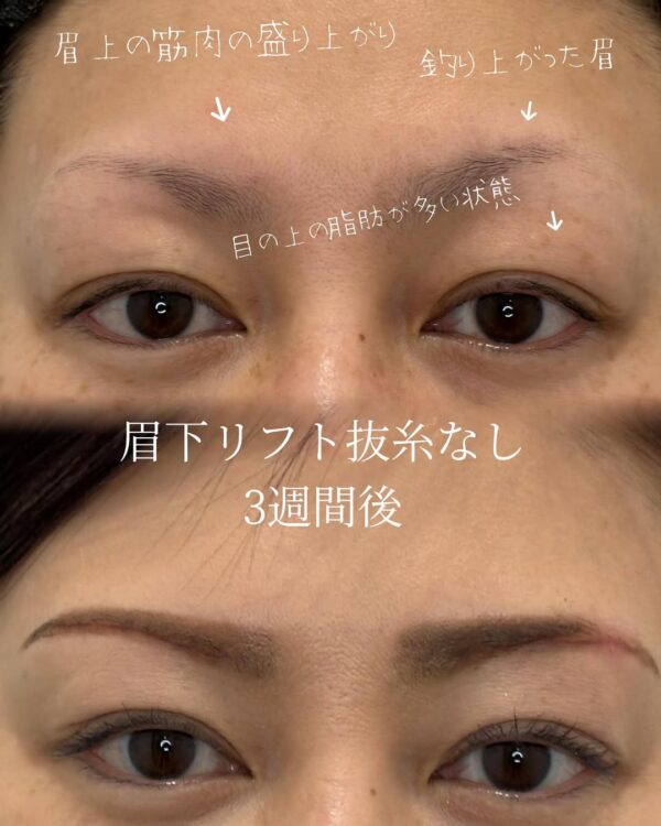 56 眉下リフト