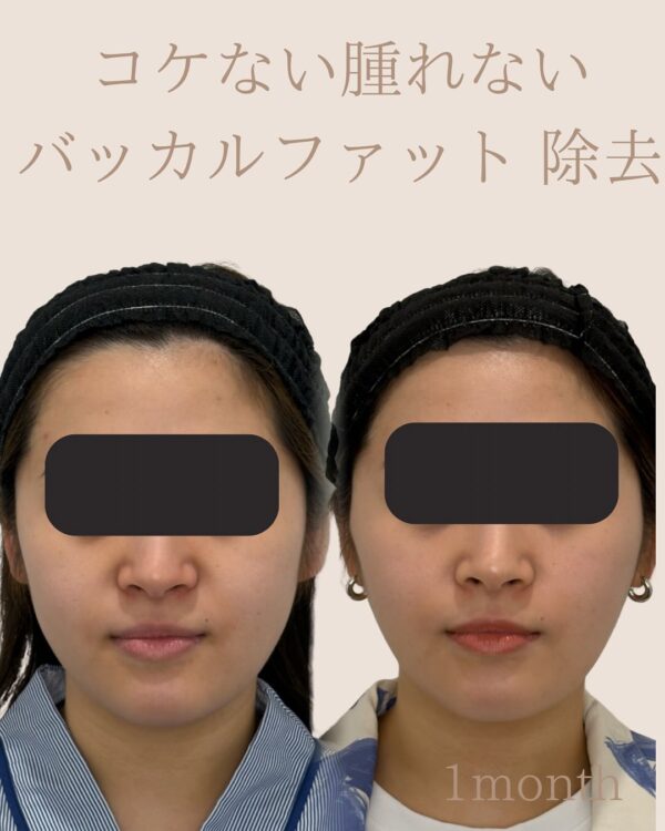 60 バッカルファット除去 × Olivia lift