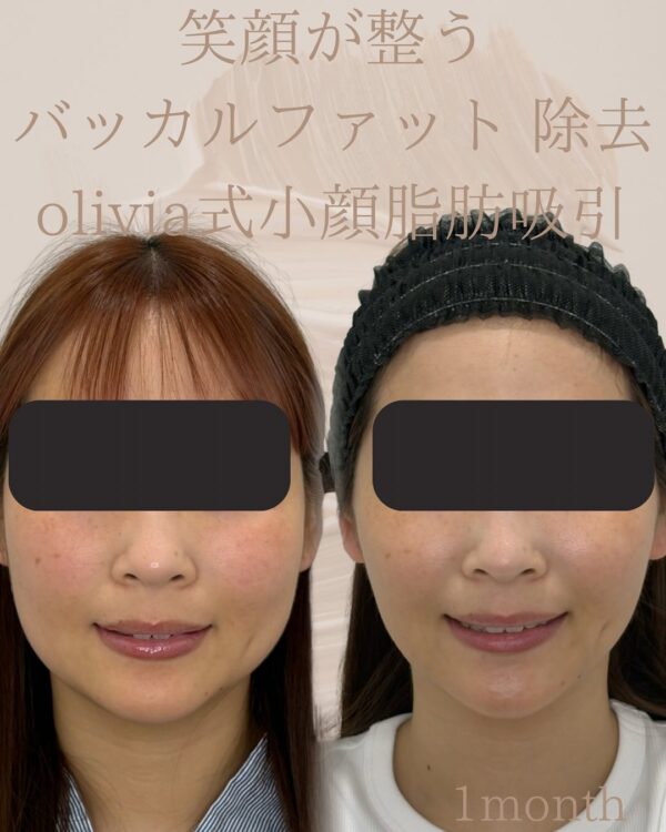 62 バッカルファット除去 × Olivia式小顔脂肪吸引