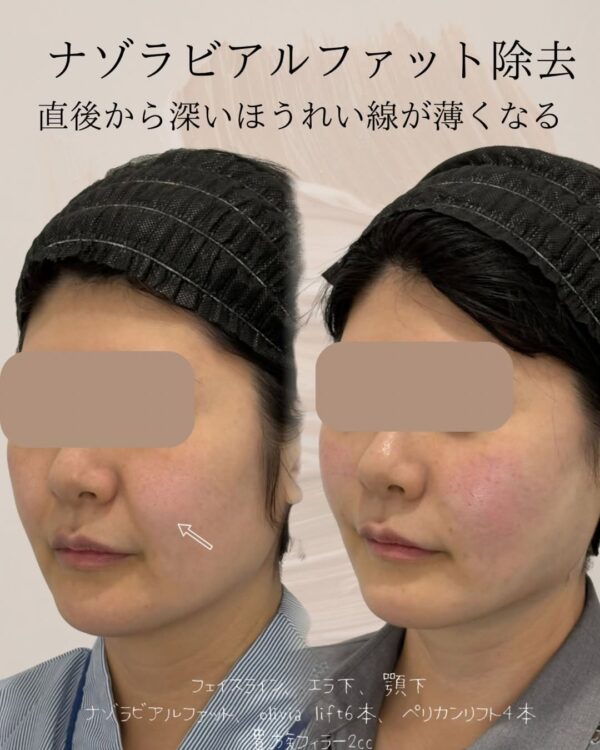 64 ナゾラビアルファット除去 × Olivia lift × ペリカンリフト× 貴族フィラー