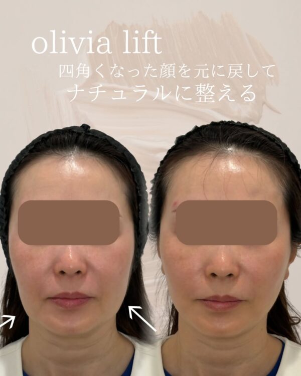 65 Olivia lift