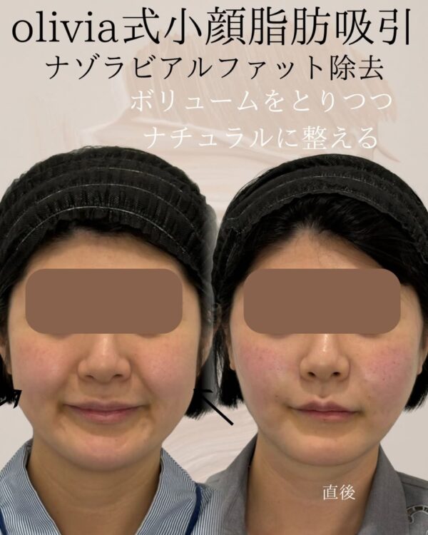 67 Olivia式小顔脂肪吸引 × ナゾラビアルファット除去 × ヒアルロン酸