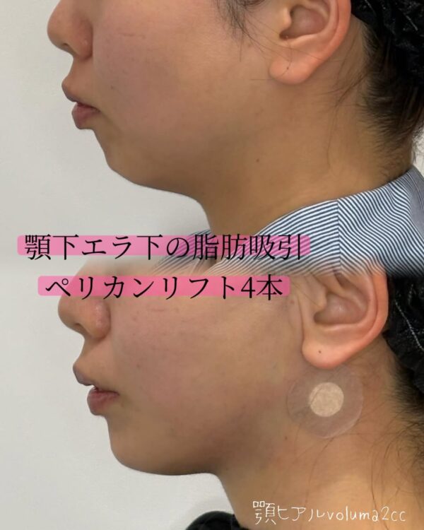 68 Olivia式小顔脂肪吸引 × ペリカンリフト × ヒアルロン酸