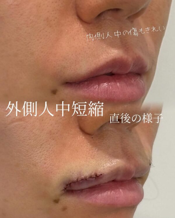 73 人中短縮切開 × ボトックス注射