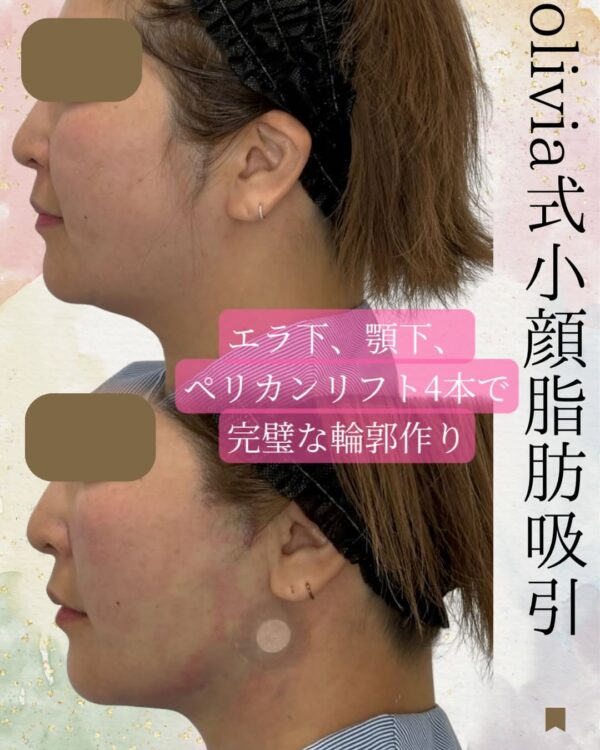 74 Olivia式小顔脂肪吸引 × ペリカンリフト