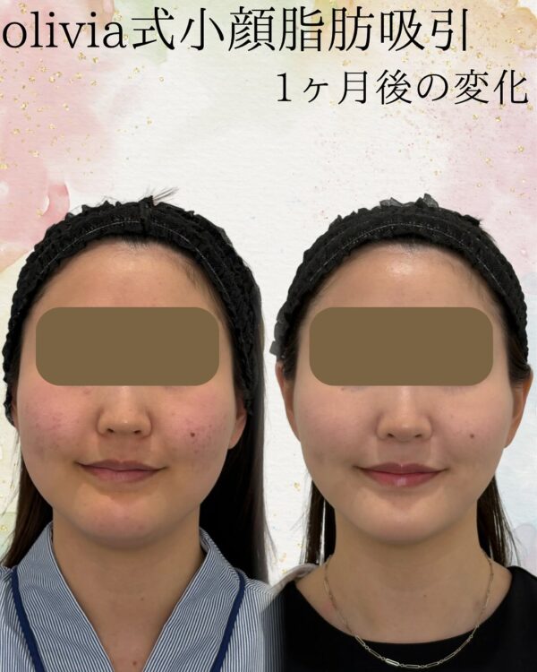 75 Olivia式小顔脂肪吸引 × バッカルファット除去 × Olivia lift