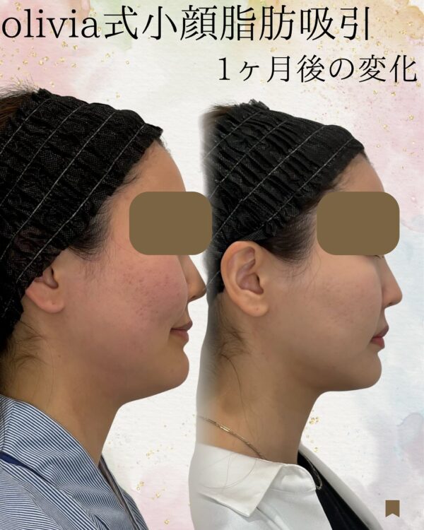 76 Olivia式小顔脂肪吸引 × ペリカンリフト