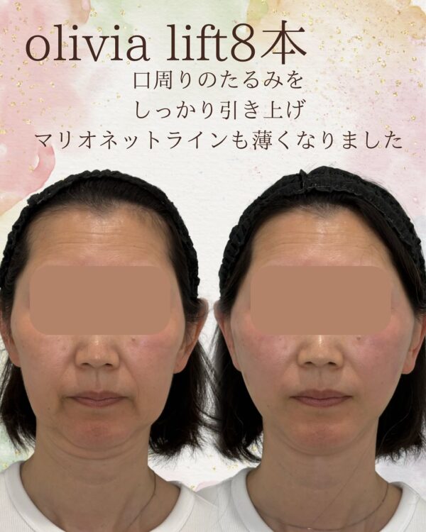 79 Olivia lift