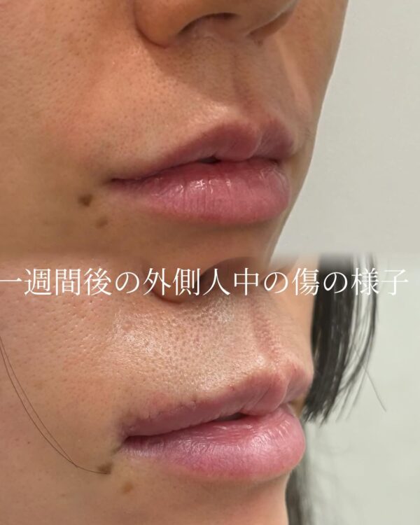 80 人中短縮切開 × ボトックス注射