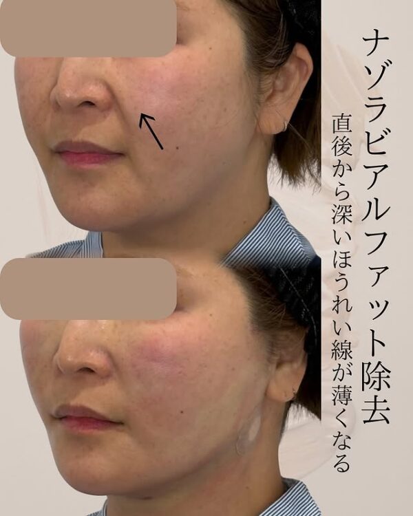 81 Olivia式小顔脂肪吸引 × ナゾラビアルファット除去 × ペリカンリフト × Olivia lift × ヒアルロン酸