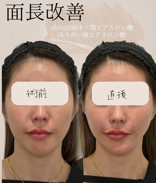 86 Olivia lift × ヒアルロン酸