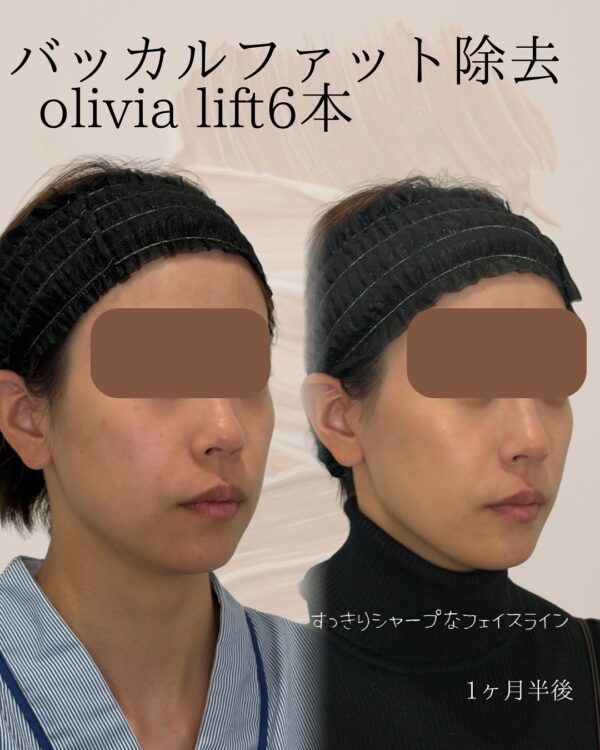 87 バッカルファット除去 × Olivia lift