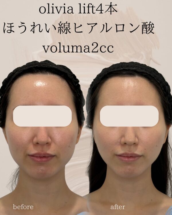 88 Olivia lift × ヒアルロン酸