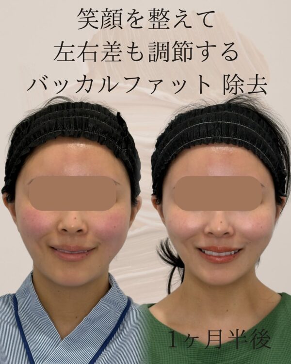 102 バッカルファット除去 × Olivia式小顔脂肪吸引
