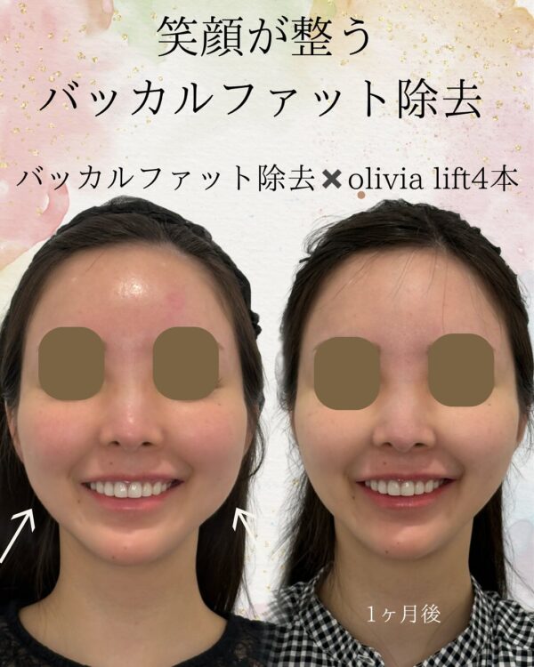 113 バッカルファット除去 × Olivia lift × ショッピングリフト × ヒアルロン酸