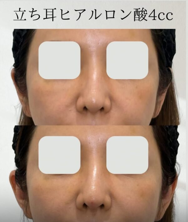 114 立ち耳ヒアルロン酸
