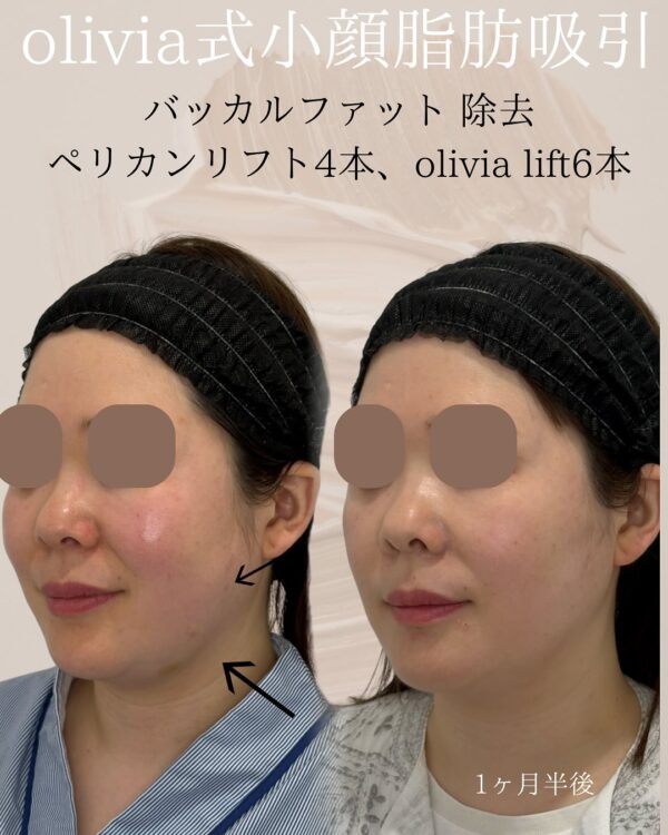 115 Olivia式小顔脂肪吸引 × バッカルファット除去 × ペリカンリフト × Olivia lift
