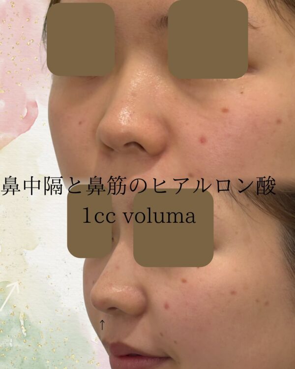 116 ヒアルロン酸