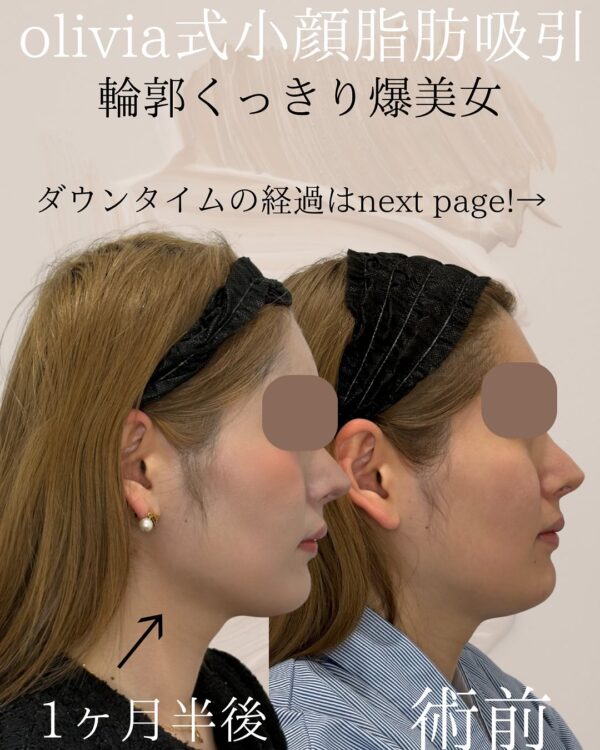 118 Olivia式小顔脂肪吸引 × ペリカンリフト × Olivia lift
