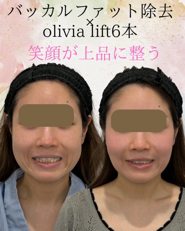 120 Olivia式小顔脂肪吸引 × バッカルファット除去 × Olivia lift
