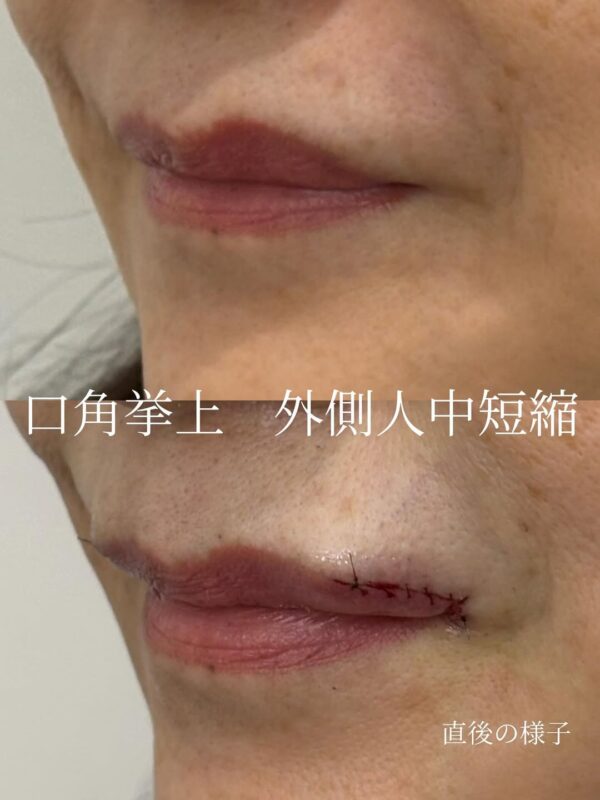 124 口角拳上 ×人中短縮切開 × ボトックス注射