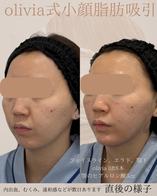 125 Olivia式小顔脂肪吸引 × Olivia lift × ヒアルロン酸