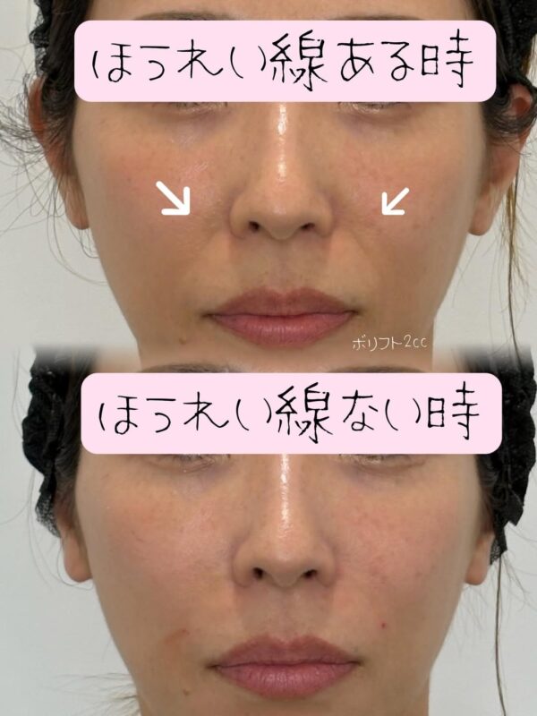 128 Olivia lift × ショッピングリフト × ヒアルロン酸