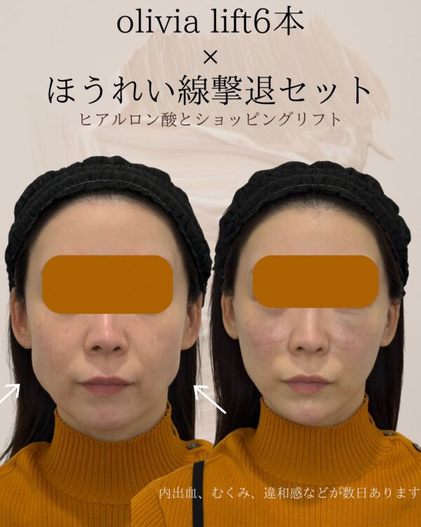 130 Olivia lift × ヒアルロン酸 × ショッピングリフト
