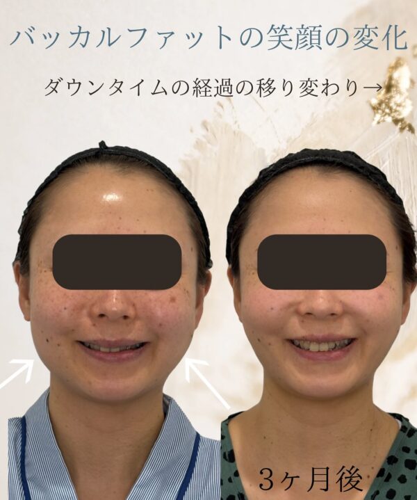 131 Olivia式小顔脂肪吸引 × バッカルファット除去