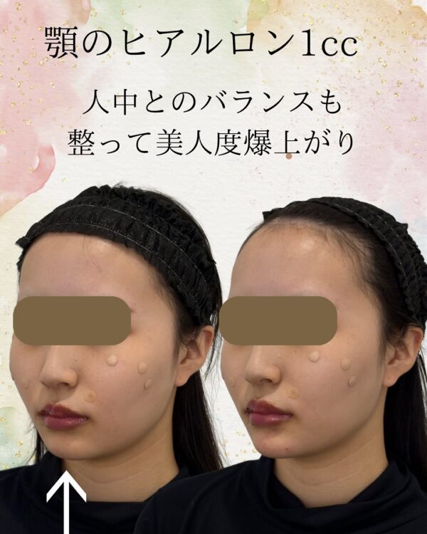 134 ヒアルロン酸