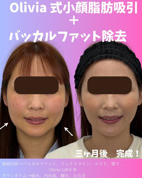 135 Olivia式小顔脂肪吸引 × バッカルファット除去 × Olivia lift