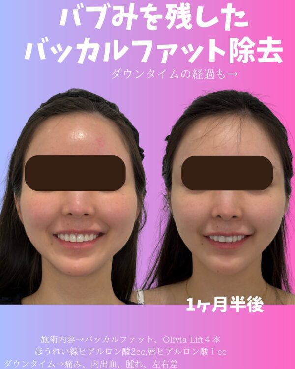 137 バッカルファット除去 × Olivia lift × ヒアルロン酸