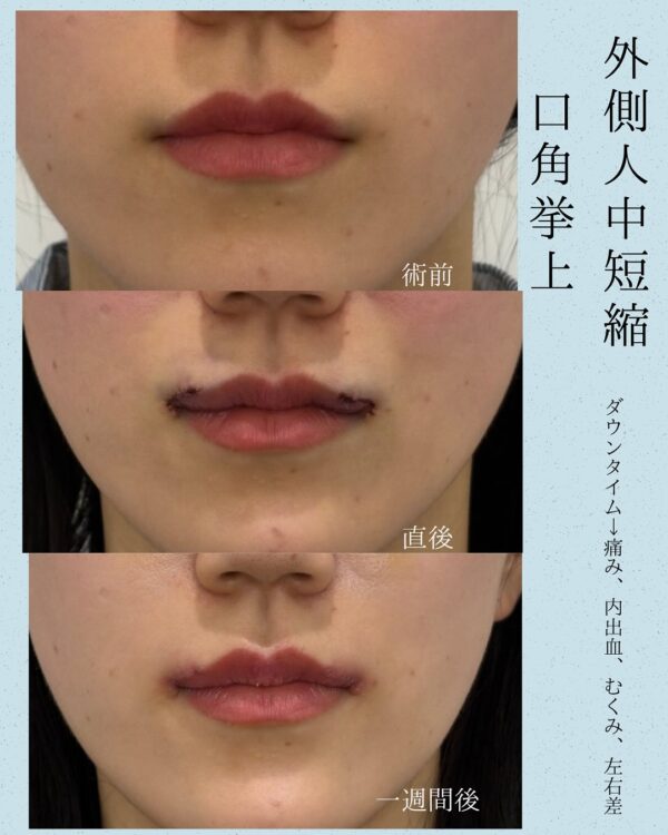 138 外側人中短縮切開 × 口角拳上 × ボトックス注射